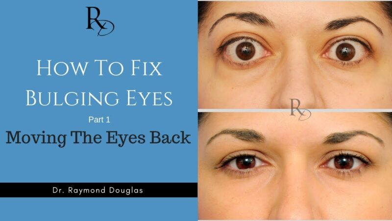 How To: Fix Bulging Eyes – Part 1 – Moving The Eyes Back  tips of the day #howtofix #technology #today #viral #fix #technique