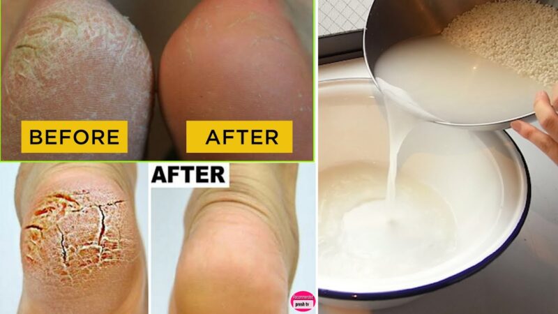 How to fix cracked heels permanently at home in 10 minutes (Rice Water)  tips of the day #howtofix #technology #today #viral #fix #technique