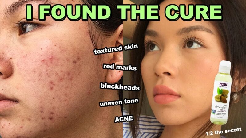 How to fix ACNE, RED MARKS &TEXTURED SKIN in 1 week (it works)  tips of the day #howtofix #technology #today #viral #fix #technique