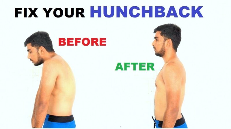How to Fix Hunch Back(Thoracic Kyphosis)| Posture correction| (In Hindi)  tips of the day #howtofix #technology #today #viral #fix #technique